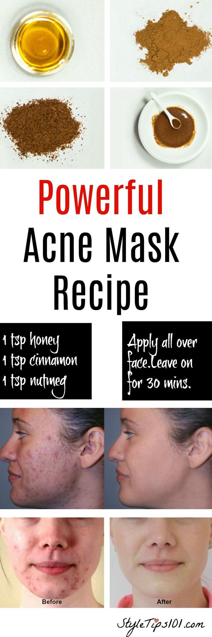 Acne Mask DIY
 Homemade Natural Acne Mask Detox